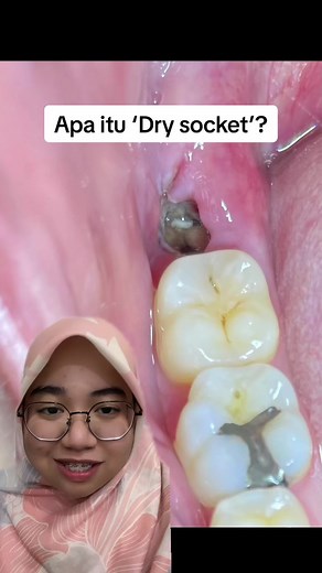 Apa itu ‘Dry socket’?