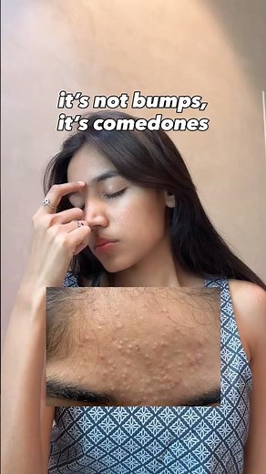 COMEDONES ON FACE‼️ check description #comedones #bumps #acne #bumpyskin #textureonface #skincare