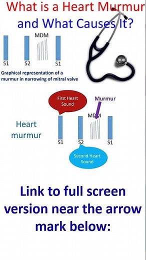 What is a heart murmur and what causes it?