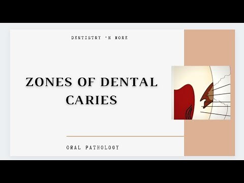 DENTAL CARIES ZONES