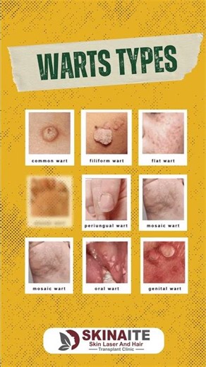 Wart Removal Treatment in Jaipur | Types of Warts & Best Wart Removal Options | Skinaite Clinic