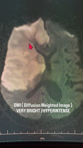 ACUTE BRAIN INFARCT ON MRI 🧠 #mriscan #brain #stroke #neurosurgeon #radiology