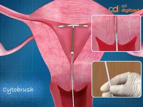 Intra Uterine Device (IUD) Copper T Animation | ADMAA