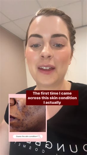 Dermal Education on Instagram: "🧠 SKIN CONDITION REVEAL: Post-Inflammatory Hyperpigmentation (PIH) When I first started working in the industry, I remember seeing this condition and thinking, “What even is that?” It’s one of those tricky presentations that can easily be confused with other pigmentation types — but once you understand the process behind it, everything clicks. 🩸 What it is: Post-inflammatory hyperpigmentation is the skin’s response to trauma or inflammation — think acne, picking