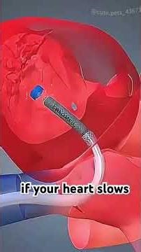 How Heart Pacemaker Works? (3D Animation)#pacemaker #pacemakers #heartpacemaker #heartattack