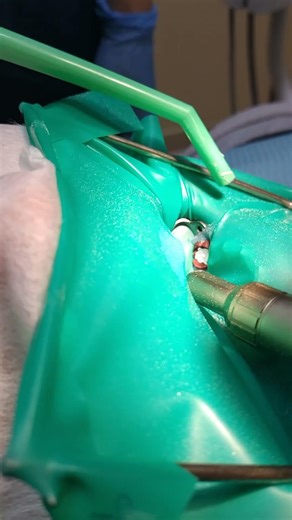 Sandblasting 36 tooth.#abrasiveblasting