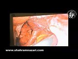 Laparoscopic Management of Totally Intra-Thoracic Stomach with Chronic Volvulus • Video • MEDtube.net