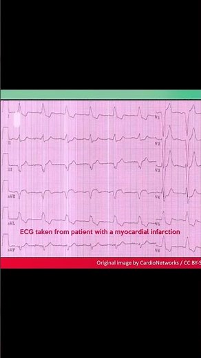 Left bundle branch block (LBBB) ECG: Example 9