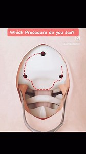 254K views · 1.2K reactions | Which Procedure do you see? | Medical Talks | Facebook