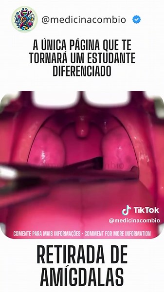 Tonsilectomia: Entenda a Cirurgia de Retirada de Amígdalas