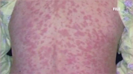 Maine CDC launching measles dashboard