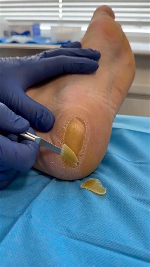 Retail Heel Sneaker: The most satisfying medically realistic pass🩺🦶🧼#ClinicalCleaning #RealProcedure