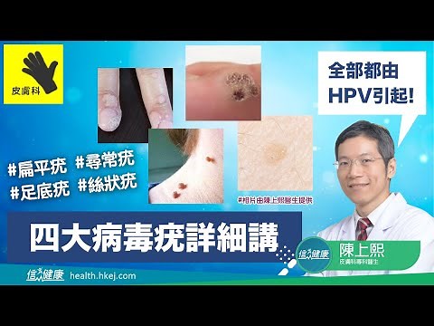 【皮膚百科】四大病毒疣詳細講