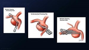 #108: Mini Pterional Craniotomy for Clip Reconstruction of a Middle Cerebral Artery Aneurysm - Aneurysm - Seven Series Collection