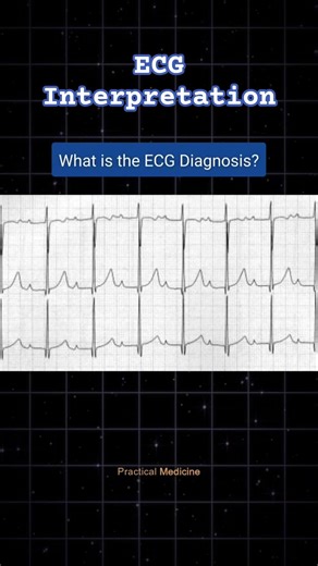 What is the ECG Diagnosis? #ECGinterpretation #ECGtest #ECGdiagnosis #HeartBlock #AVblocks #ECG