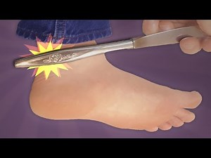 The Ankle Sign of Hypothyroidism