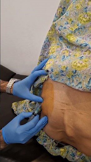 How to do pleural tap #clinicalexamination #doctor