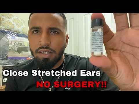 Simple Ways to Close an Earlobe Piercing: 8 Steps (with Pictures)