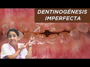 Dentinogénesis imperfecta: ¿qué es? ¿por qué sucede?