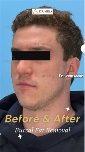 Buccal Fat Removal by Dr. Mesa | Still feeling that “chunky smile” no matter how much weight you lose? You’re not alone 👇 Buccal Fat Removal is one of the most effective... | Instagram