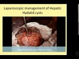 Laparoscopic Management of Hydatid Cysts of Liver • Video • MEDtube.net