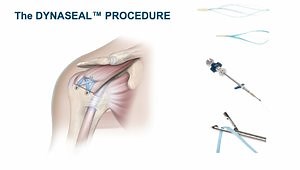 Sealing the Medial Footprint with the DYNASEAL Technique for Rotator Cuff Repair