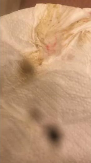 I’m bleeding from anal rape