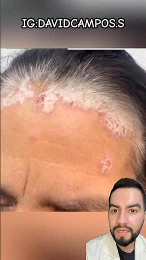 PSORIASIS AND SEBORRHEIC DERMATITIS