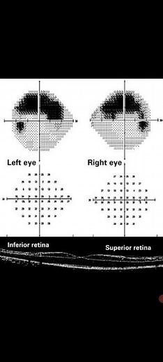 Altitudinal Visual Field Defect( Arcuate Scotoma) grass Awerenes of All grass images of Eye 👁‍🗨