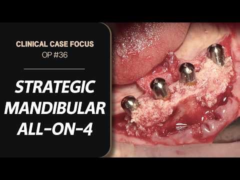 Strategic Mandibular All-on-4 Implant Surgery | 하악 전악 재건을 위한 전략적 All-on-4 수술법