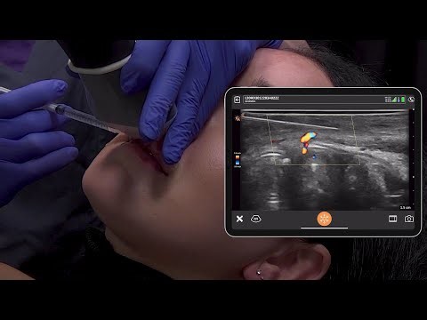 Ultrasound Guided Lip Filler Treatment