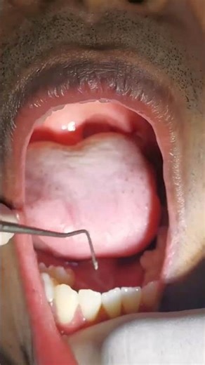 Most teeth in a person's mouth 🦷😁