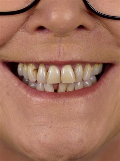 Treatment procedure: All-On-4® Dental Implants All-on-4® is a dental implant treatment to replace missing teeth with a full arch of fixed prosthetic teeth. All photos and videos are shared with full patient consent. No filters, AI alterations, or unrealistic lighting have been applied. Results, recovery times and potential risks vary for each individual and procedure. The information provided here is general in nature and intended for those over the age of 18. Undergoing any dental or cosmetic p