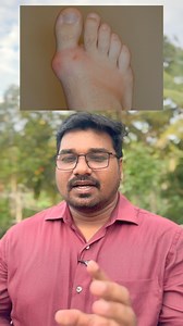 Allopurinol vs Colchicine in Gout | Allopurinol 1.  Lowers uric acid...