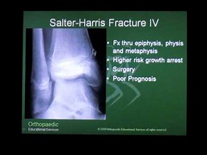 Salter Harris Fracture - Pediatrics