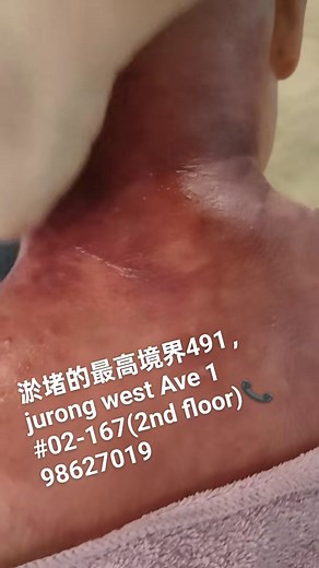 ZU YI SHENG TCM服务项目身体按摩，经络推拿，淋巴排毒，胸部护理刮痧，子宫，卵巢保养，拔罐，面部护理，踩背，采耳，点痣，祛疣，脱毛，专业修脚.无痛灰指甲、手足癣、甲沟炎、嵌甲矫正、鸡眼、脚疔、病毒疣、瘊子、脚垫、老茧、手足湿疹皮炎、足疗、手足养护精修等. 地址：504 west coast Dr Singapore 120504 01-224 ​地址：491 Jurong West Ave 1#02-167 S640491（电梯上二楼） | Spa EVIAN