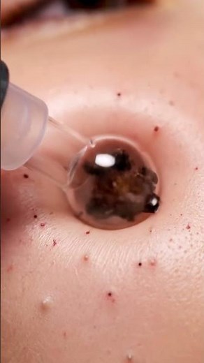Blackhead Plug Removal — Super Close