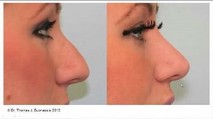 Hump Reduction, Tip Rotation, and Tip Refinement: The Doctor Explains This Woman's Nose Job