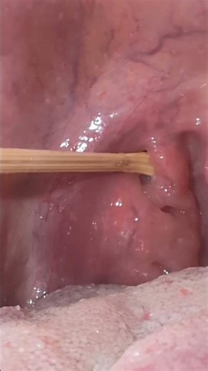 Deep tonsil stone extraction