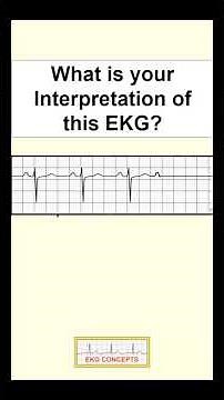 EKG Rhythm Quiz #4 In less than 2 minutes, test your EKG skills: ekgconcepts.com