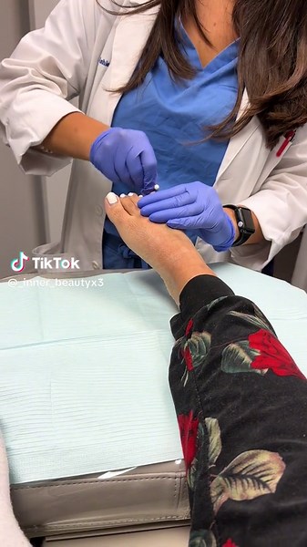 Pin removal after 6 weeks! Ouch 🦴😬 #pinremoval #brokenbone #brokentoe #castremoval #kwiremoval #pinkytoe #fracture #fyp #orthopedicsurgery