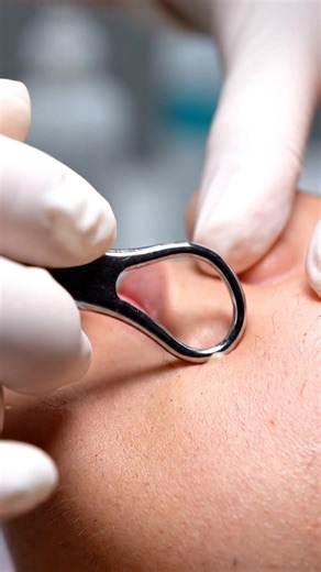 Relaxing ASMR Pimple Every Day. #ASMR #BlackheadRemoval #PimplePopping #DermatologistASMR #SatisfyingVideo #NoTalkingASMR #4KASMR #DeepPoreCleaning #SpaFacial #RelaxingASMR | Bananas ASMR