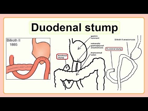 duodenal stump