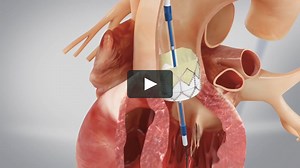 TAVI transfemoral - Transcatheter Aortic Heart Valve - Animation