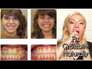 How To Fix Crossbite Teeth Naturally Without Surgery, Without Braces | Cross-Bite Teeth Correction