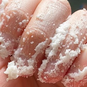 132K views · 132 reactions | Keratosis pilaris, or strawberry skin,...