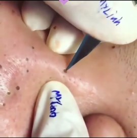 Pimple Popping 2021 | Rate this video 1-10? . . . #popping #pimplepoppingvideos | Instagram