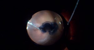 Retinal Surgery Full of Surprises - Eyetube