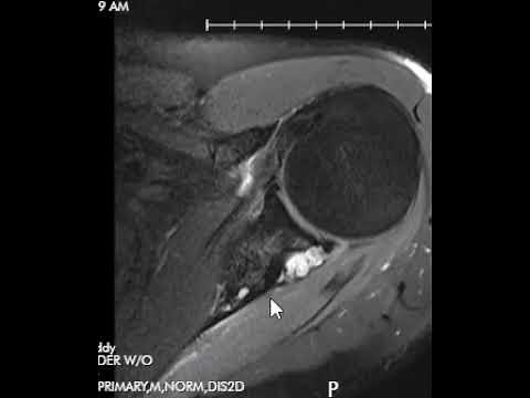 Ganglion cyst in spinoglenoid notch