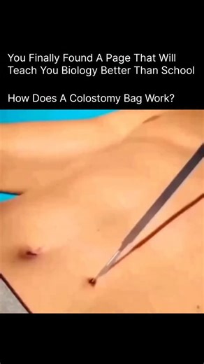 BIOLOGY | MEDICAL | HEALTH on Instagram: "A colostomy bag is a medical pouch that collects waste when part of the large intestine is no longer able to pass stool normally. During a colostomy surgery, doctors create a small opening in the abdomen called a stoma. The healthy end of the colon is gently brought out through this opening, allowing waste to leave the body safely. The colostomy bag sticks securely over the stoma and works like an external temporary toilet. As digestion continues normall